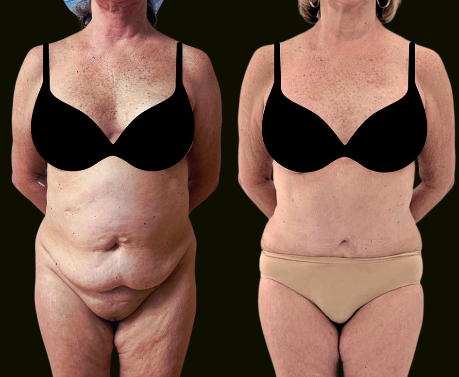 Fort Lauderdale Tummy Tuck Before and After