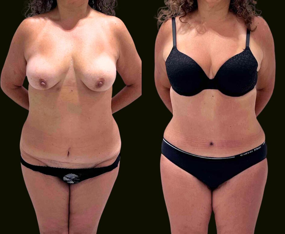 Tummy Tuck Fort Lauderdale Before and After