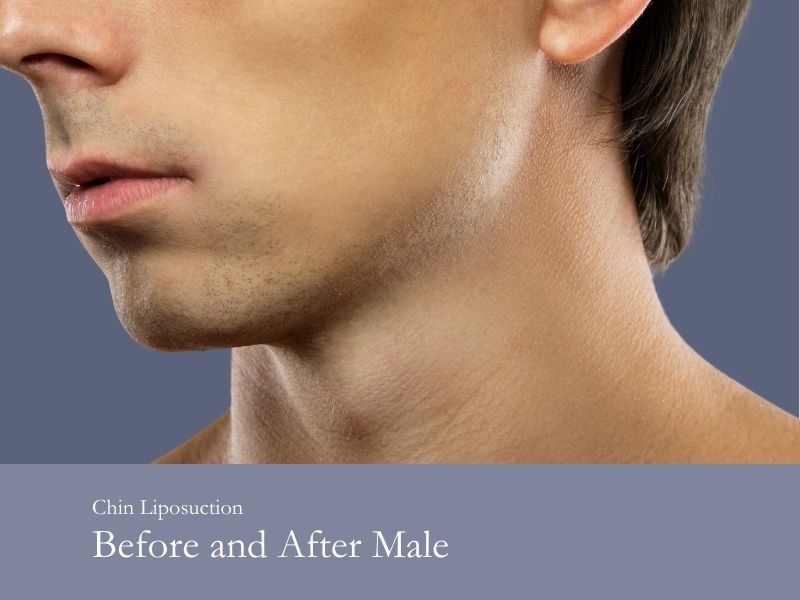 chin liposuction before and after male