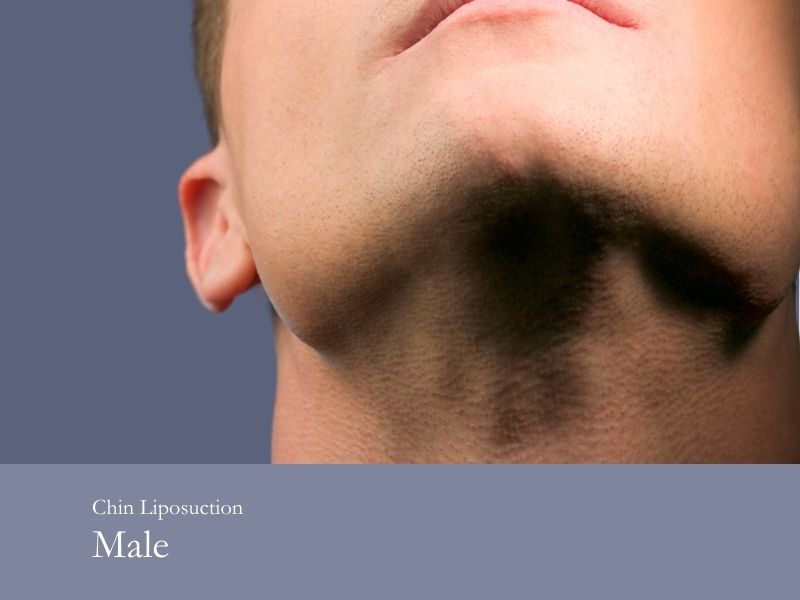 chin liposuction male