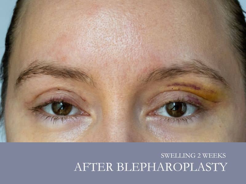 swelling 2 weeks after blepharoplasty