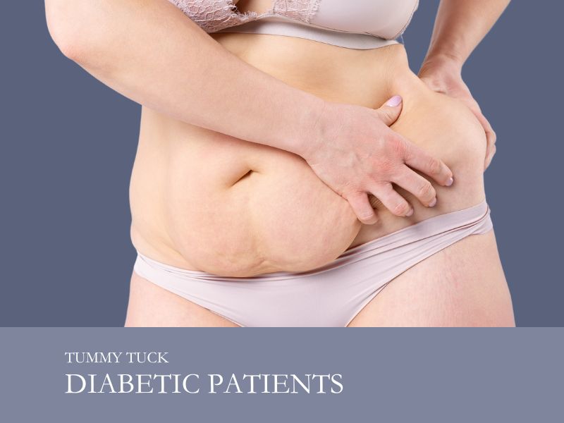 Tummy Tuck Diabetic Patients